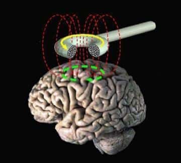 "Illustration of how transcranial magnetic stimulation works"ⓒ Eric Wassermann, M.D., Public domain, via Wikimedia Commonshttps://upload.wikimedia.org/wikipedia/commons/6/67/Transcranial_magnetic_stimulation.jpg?utm_source=commons.wikimedia.org&utm_campaign=index&utm_content=original